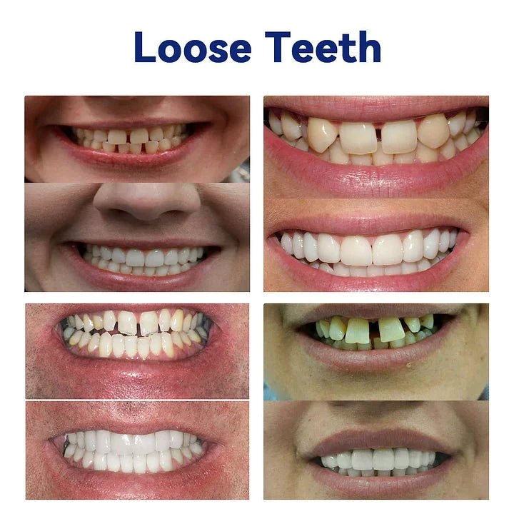 (⏰Limited-time offer: only $9.9⏰)🦷Advanced Customized Full Denture Set🦷