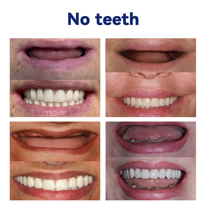 (⏰Limited-time offer: only $9.9⏰)🦷Advanced Customized Full Denture Set🦷